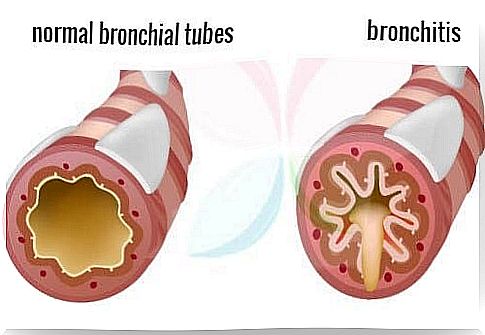 bronchitis