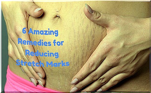 6 great remedies for stretch marks