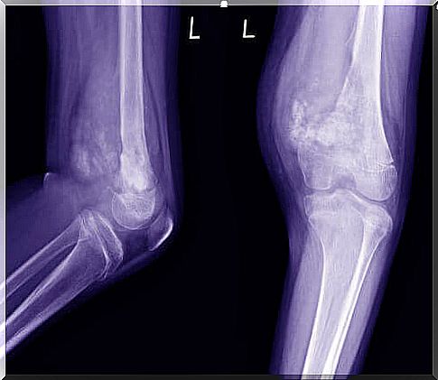 Characteristics of osteosarcoma in children