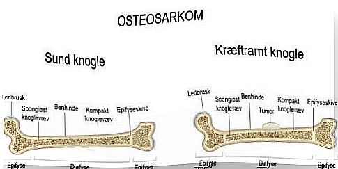 Illustration of osetosarcoma in children