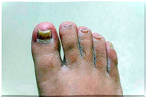 Do anti-fungal agents work on hands and feet?