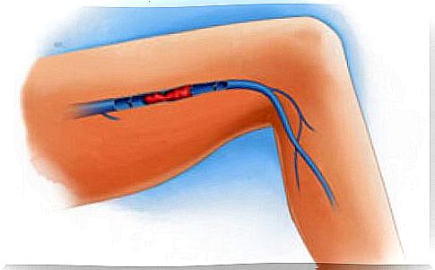 How to detect a blood clot in the leg