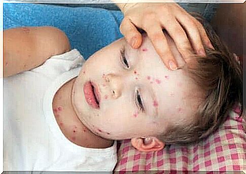 How to treat hives in children