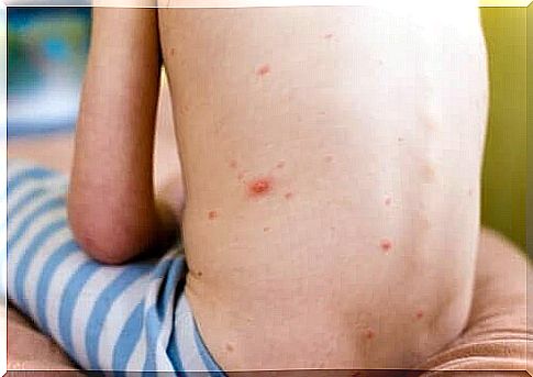 Example of hives in children