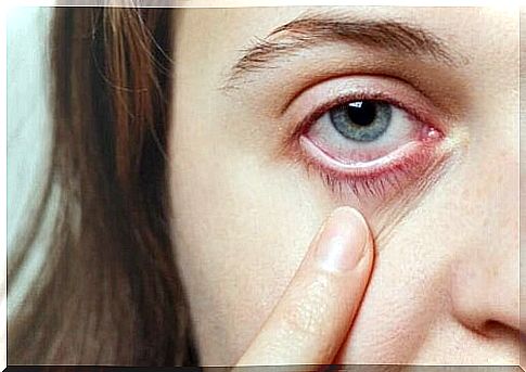 Eye migraine, also called ophthalmic migraine, refers to a condition that manifests itself with a temporary and painless visual disturbance.