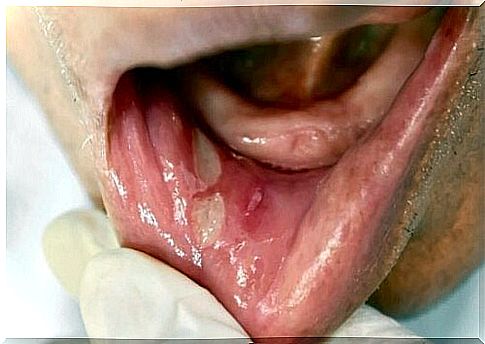 Mouth sores on the inside of the lips