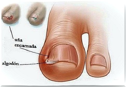 Ingrown nails - nail problems