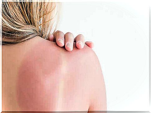 Recommendations and care of sunburn