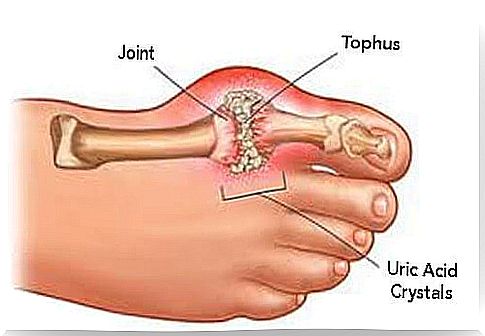 Arthritis of the joint