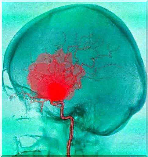 Subarachnoid and subdural hemorrhages