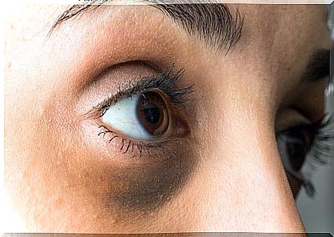 Do you have swollen bags under your eyes, or are they darker circles?