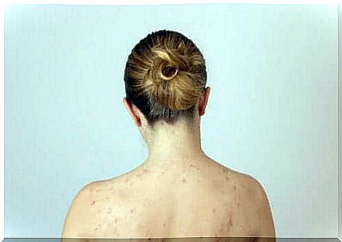 Woman with fat lumps on her back