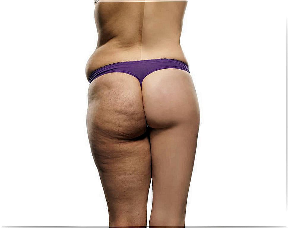 The perfect anti cellulite diet plan