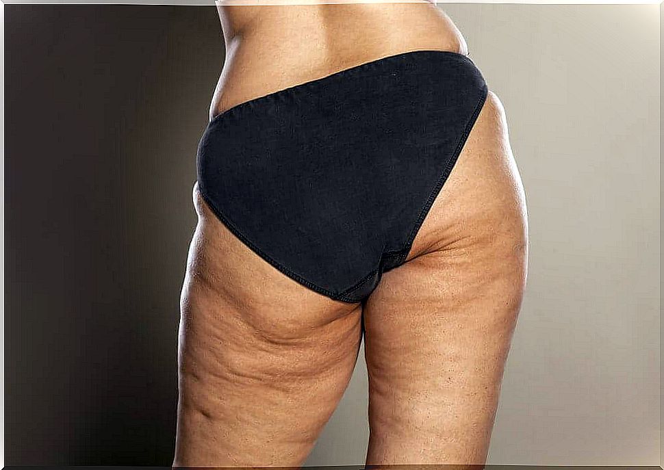 Woman with cellulite