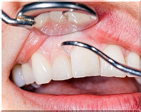 A dentist scrapes plaque off a tooth