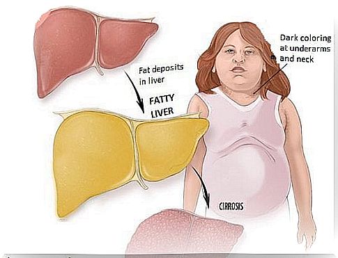 It is important that you do something to treat your fatty liver